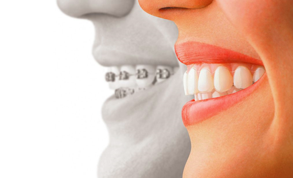 Invisalign® clear aligner trays